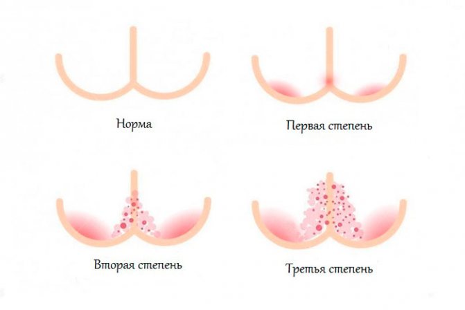 Опрелости под грудью – причины, симптомы и лечение| «СМ-Клиника»